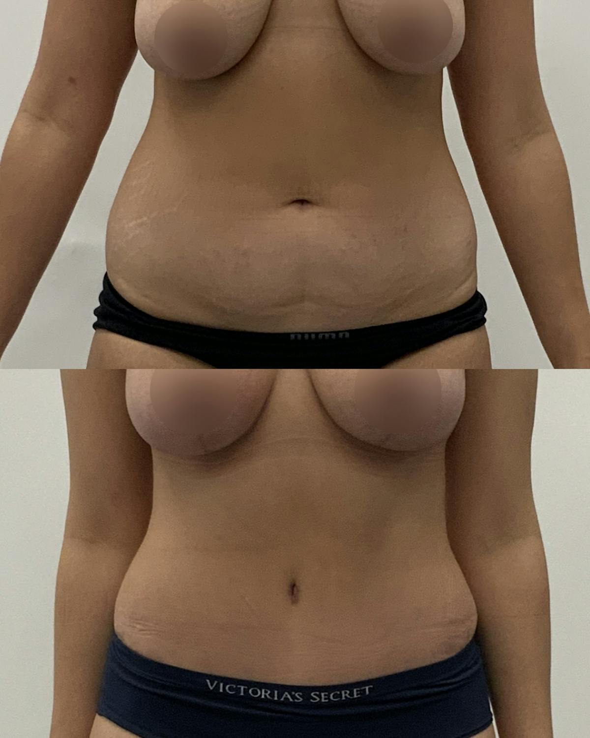 Tummy Tuck Before & After Gallery - Patient 100082 - Image 1