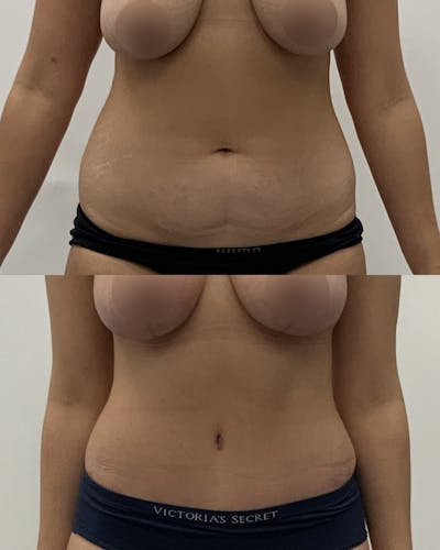Tummy Tuck Before & After Gallery - Patient 100082 - Image 1