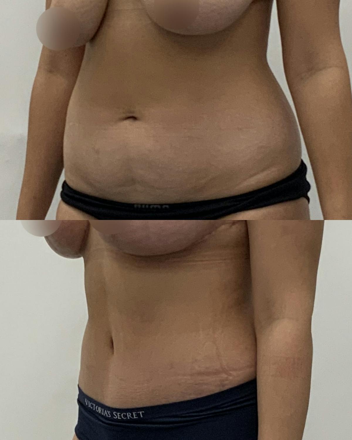Tummy Tuck Before & After Gallery - Patient 100082 - Image 2