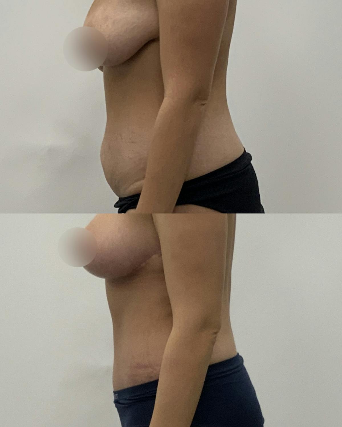 Tummy Tuck Before & After Gallery - Patient 100082 - Image 3