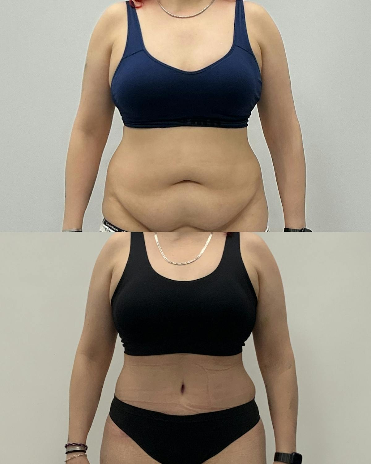 Tummy Tuck Before & After Gallery - Patient 172514 - Image 1
