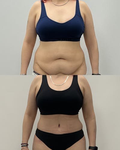 Tummy Tuck Before & After Gallery - Patient 172514 - Image 1