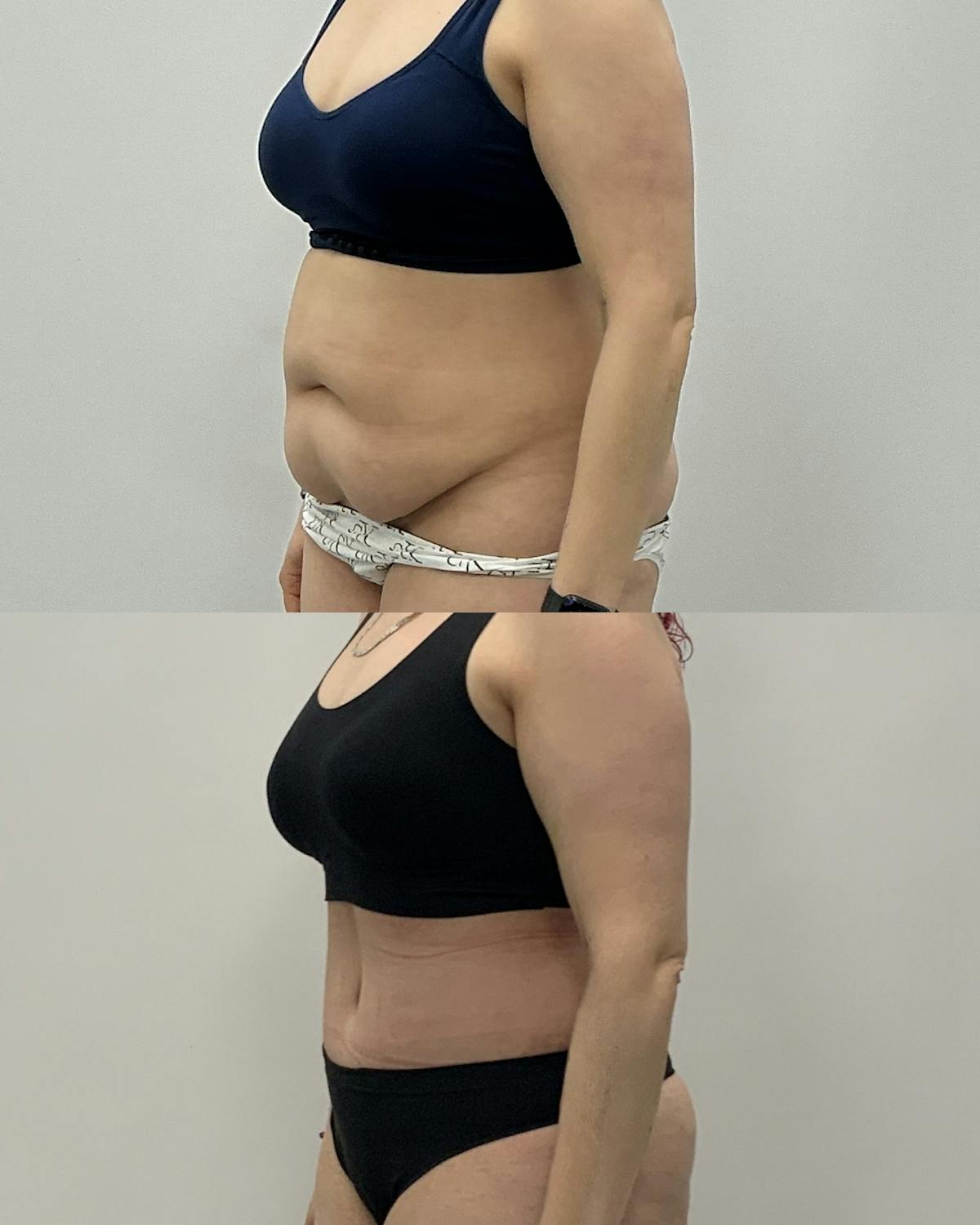 Tummy Tuck Before & After Gallery - Patient 172514 - Image 2