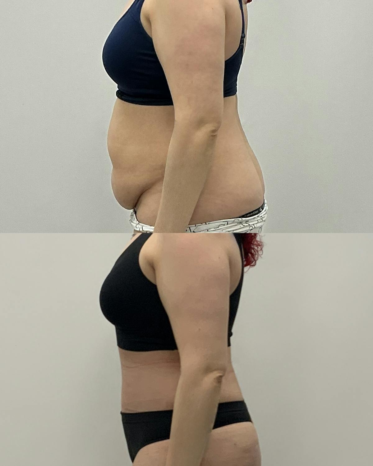 Tummy Tuck Before & After Gallery - Patient 172514 - Image 3