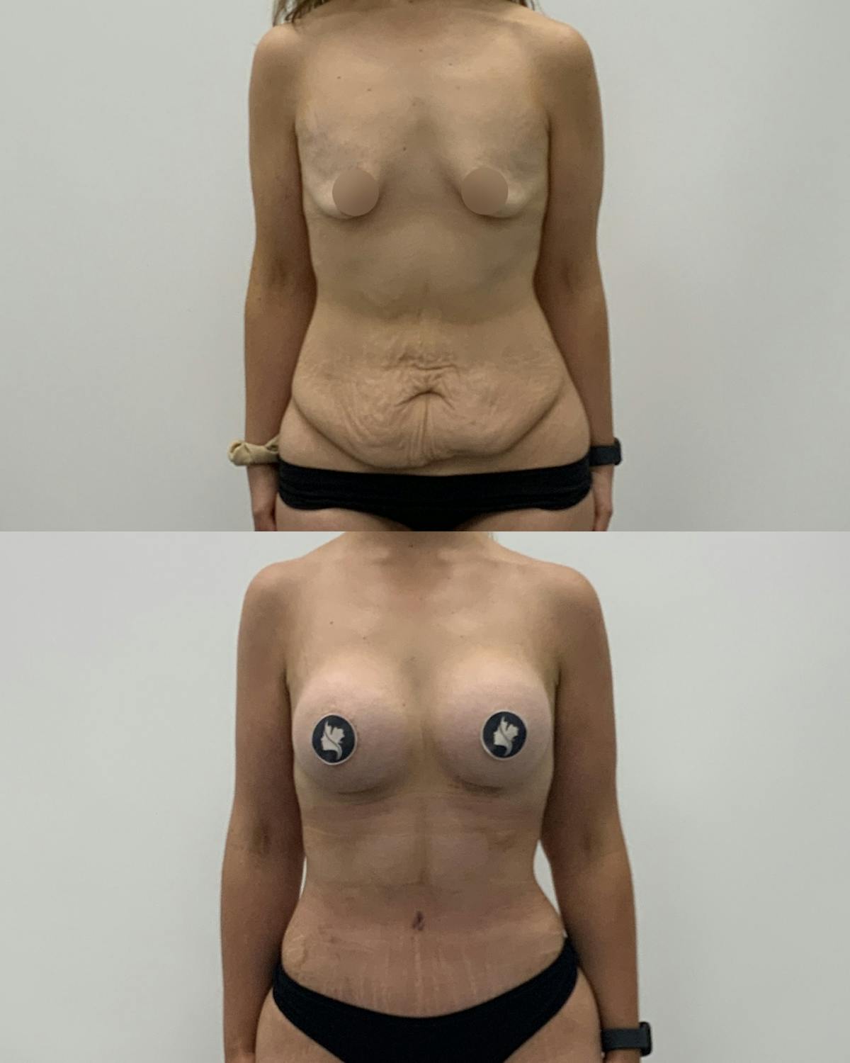 Mommy Makeover Before & After Gallery - Patient 417553 - Image 1