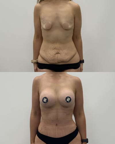 Mommy Makeover Before & After Gallery - Patient 417553 - Image 1