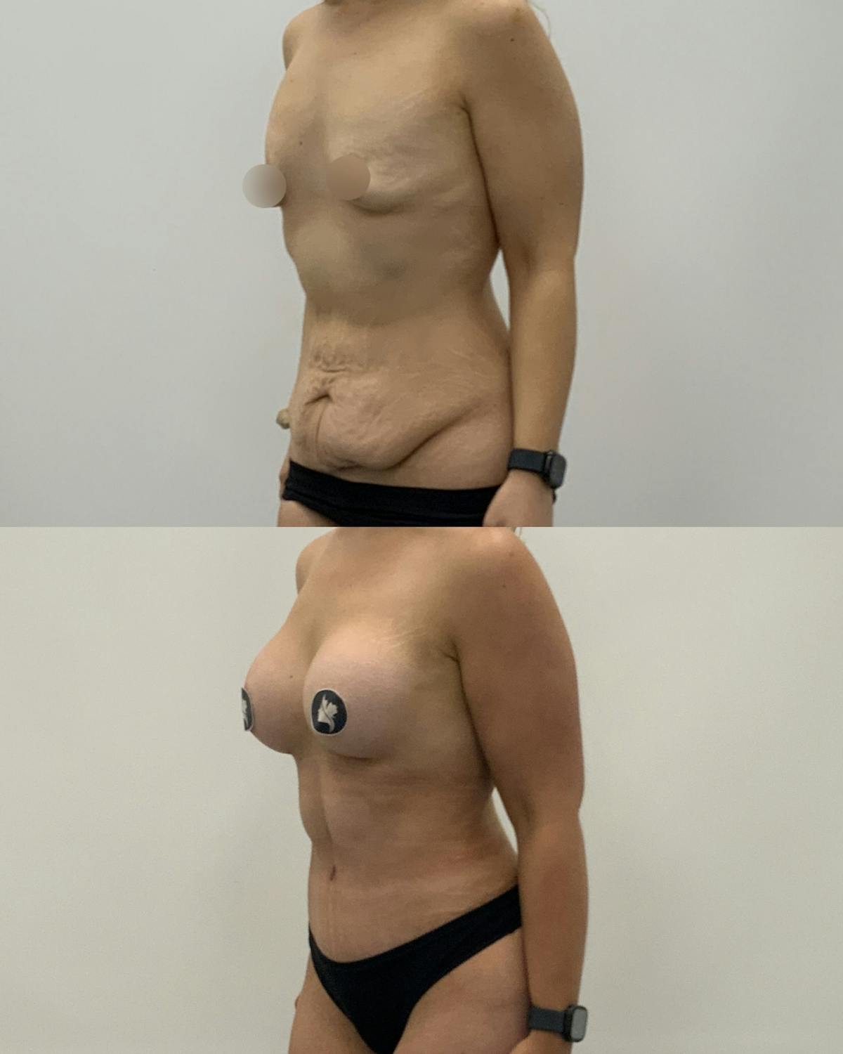 Mommy Makeover Before & After Gallery - Patient 417553 - Image 2