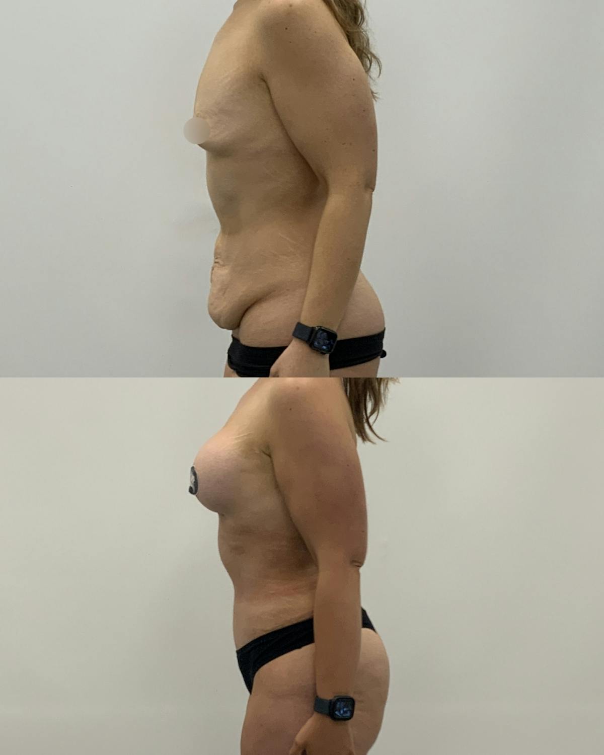 Mommy Makeover Before & After Gallery - Patient 417553 - Image 3