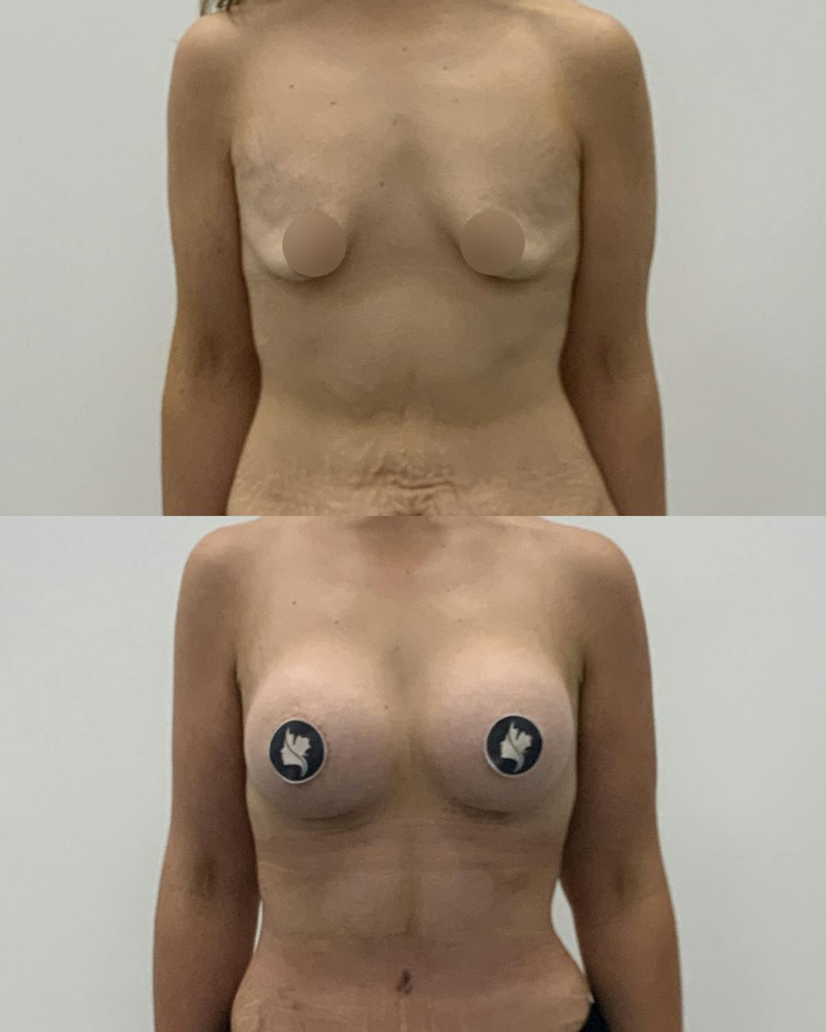 Breast Augmentation Before & After Gallery - Patient 370366 - Image 1