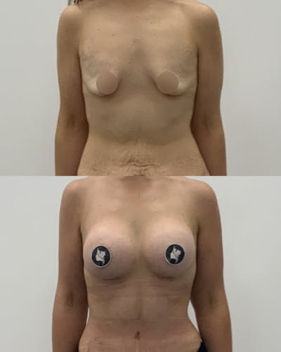 Breast Augmentation Before & After Gallery - Patient 370366 - Image 1