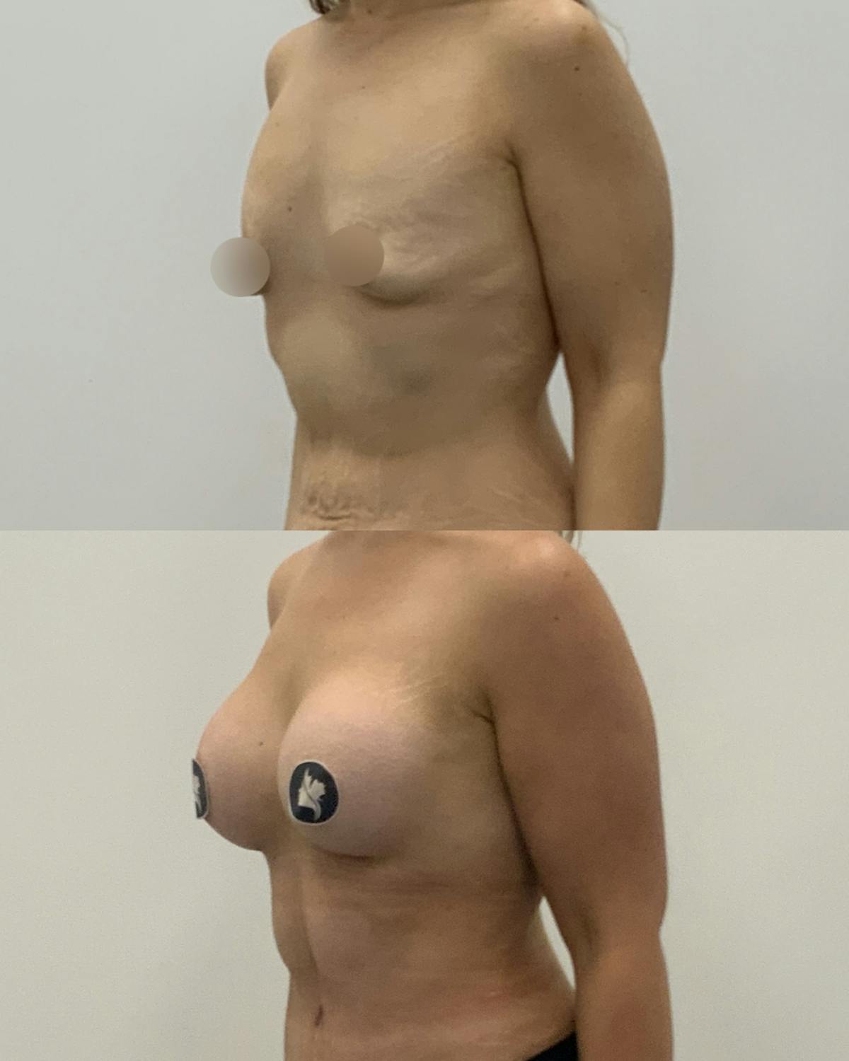 Breast Augmentation Before & After Gallery - Patient 370366 - Image 2