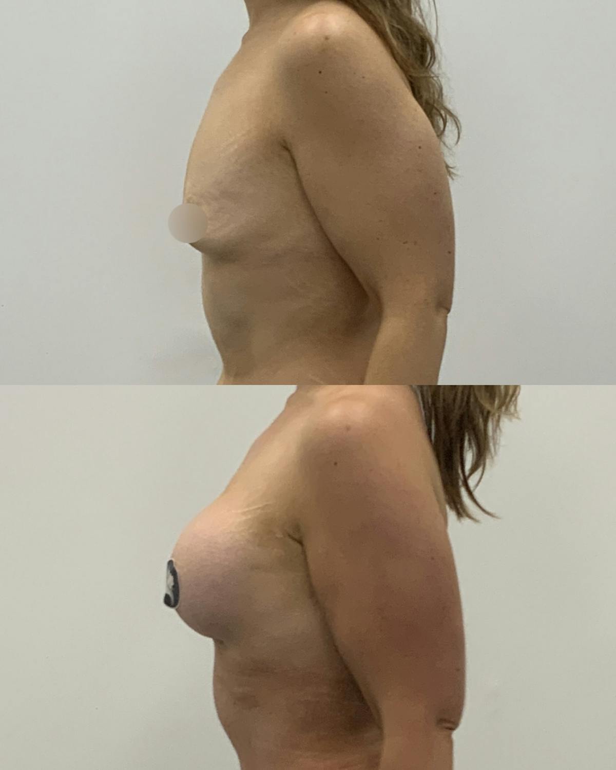 Breast Augmentation Before & After Gallery - Patient 370366 - Image 3