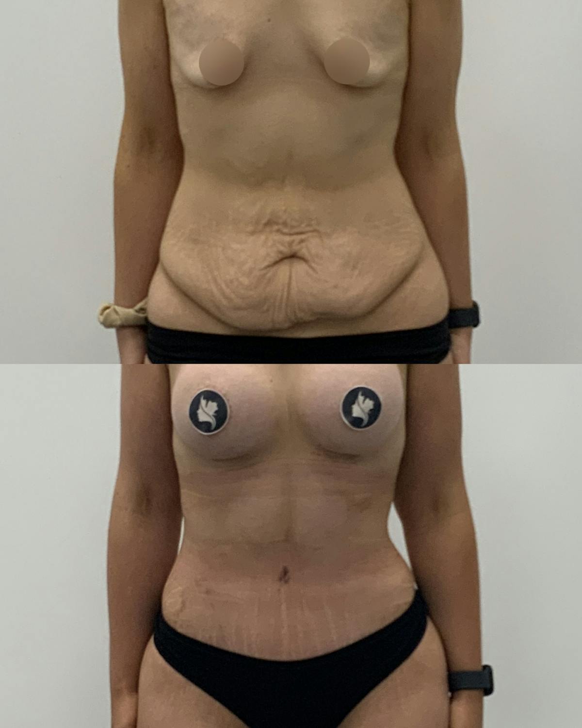 Tummy Tuck Before & After Gallery - Patient 354400 - Image 1