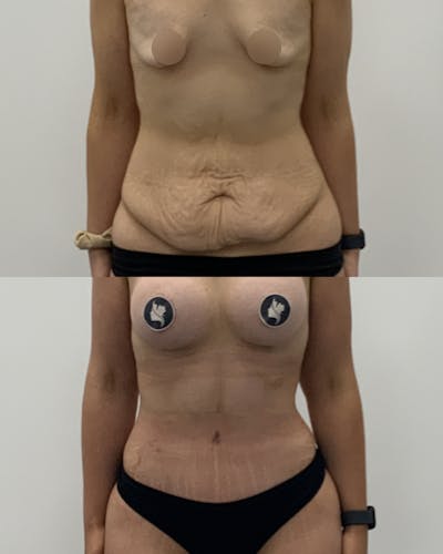 Tummy Tuck Before & After Gallery - Patient 354400 - Image 1