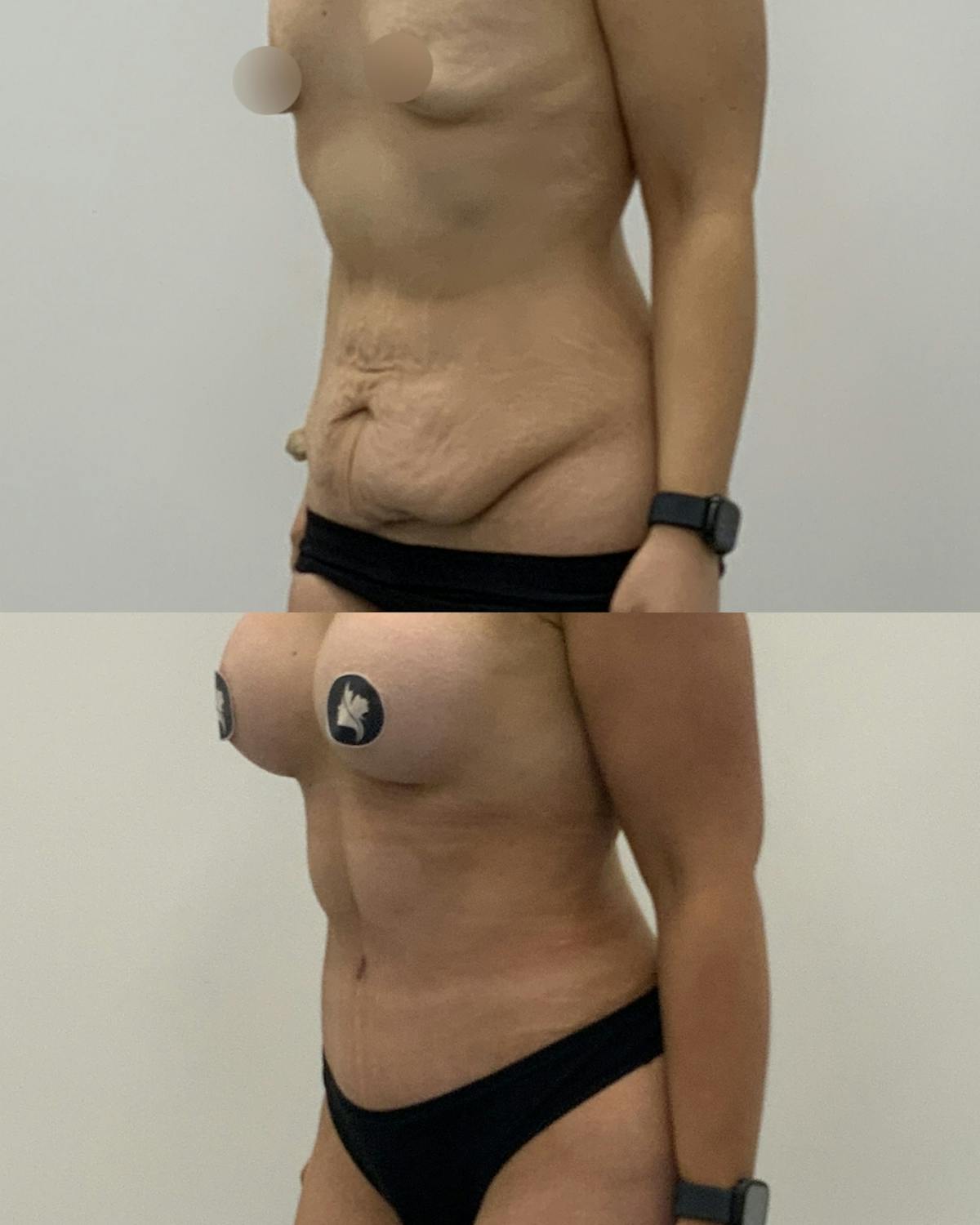 Tummy Tuck Before & After Gallery - Patient 354400 - Image 2