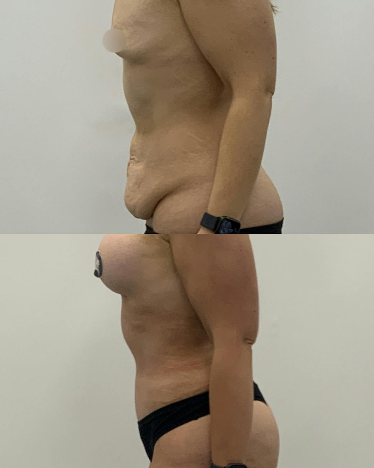 Tummy Tuck Before & After Gallery - Patient 354400 - Image 3
