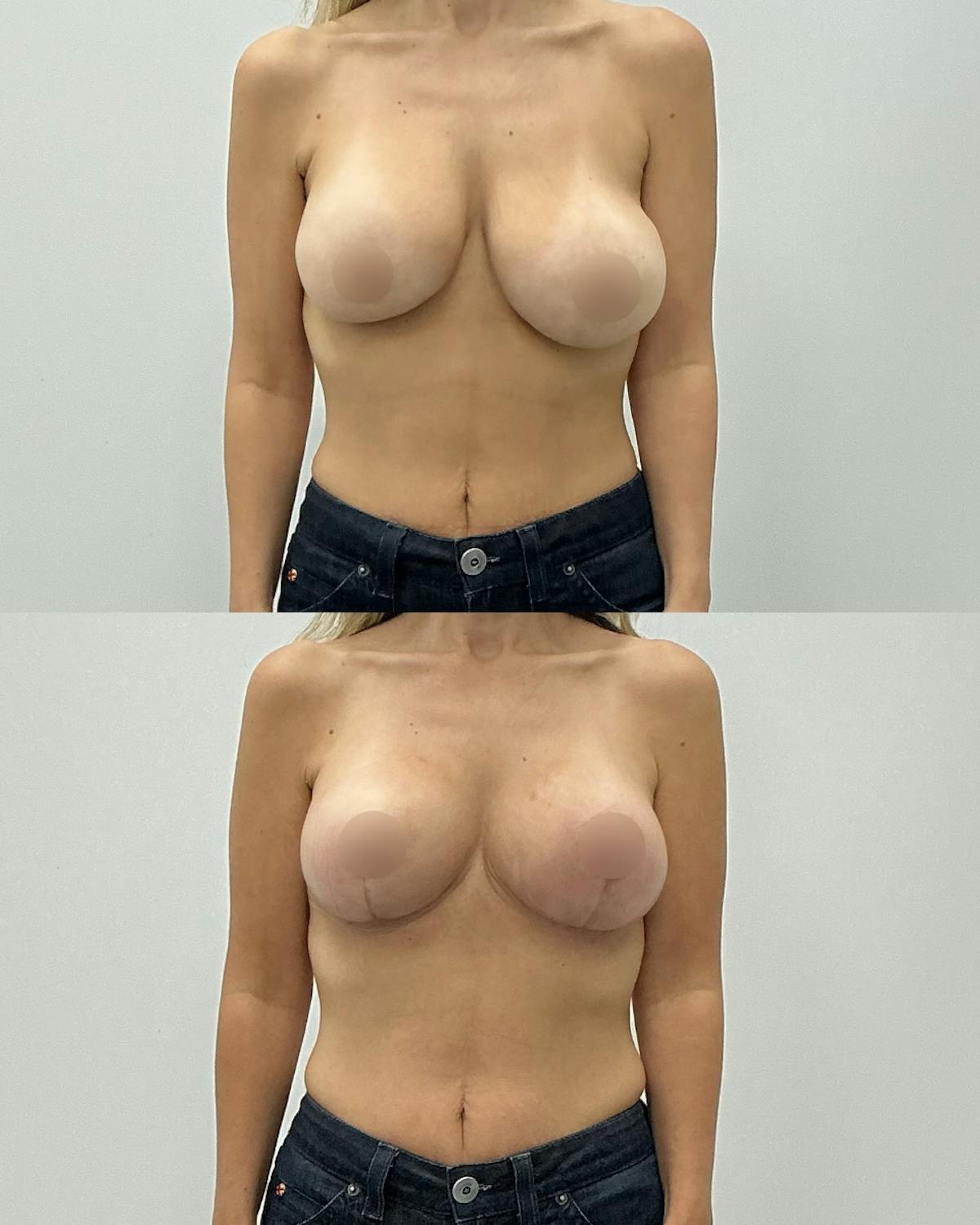Breast Asymmetry Correction Before & After Gallery - Patient 458996 - Image 1