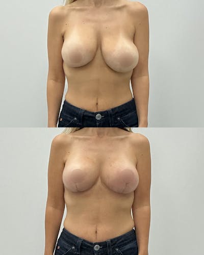 Breast Lift Before & After Gallery - Patient 354757 - Image 1
