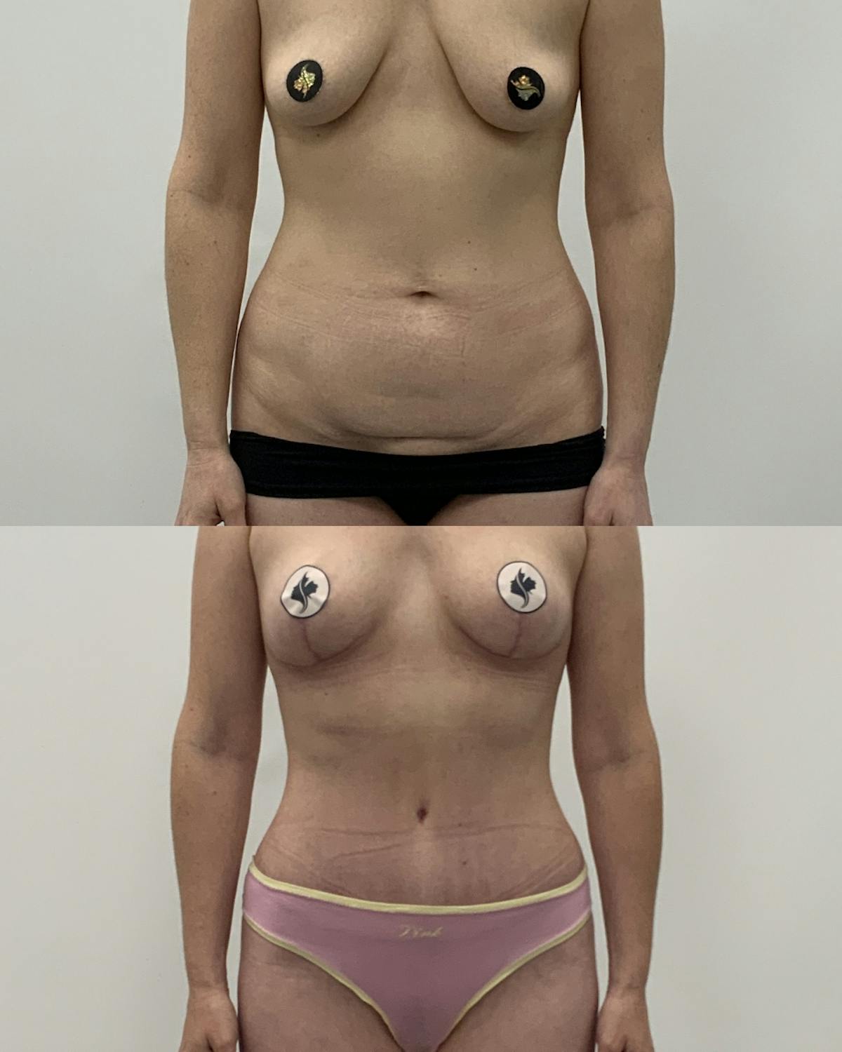 Tummy Tuck Before & After Gallery - Patient 243321 - Image 1