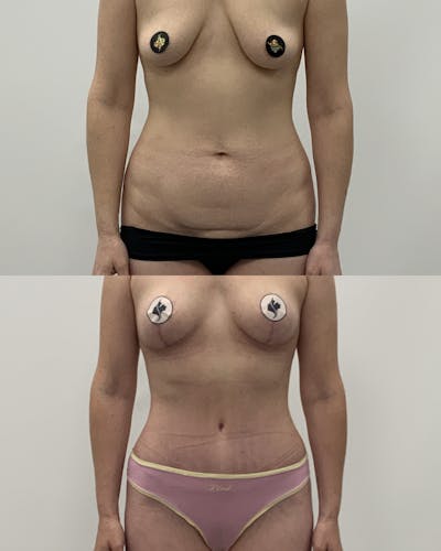 Tummy Tuck Before & After Gallery - Patient 243321 - Image 1