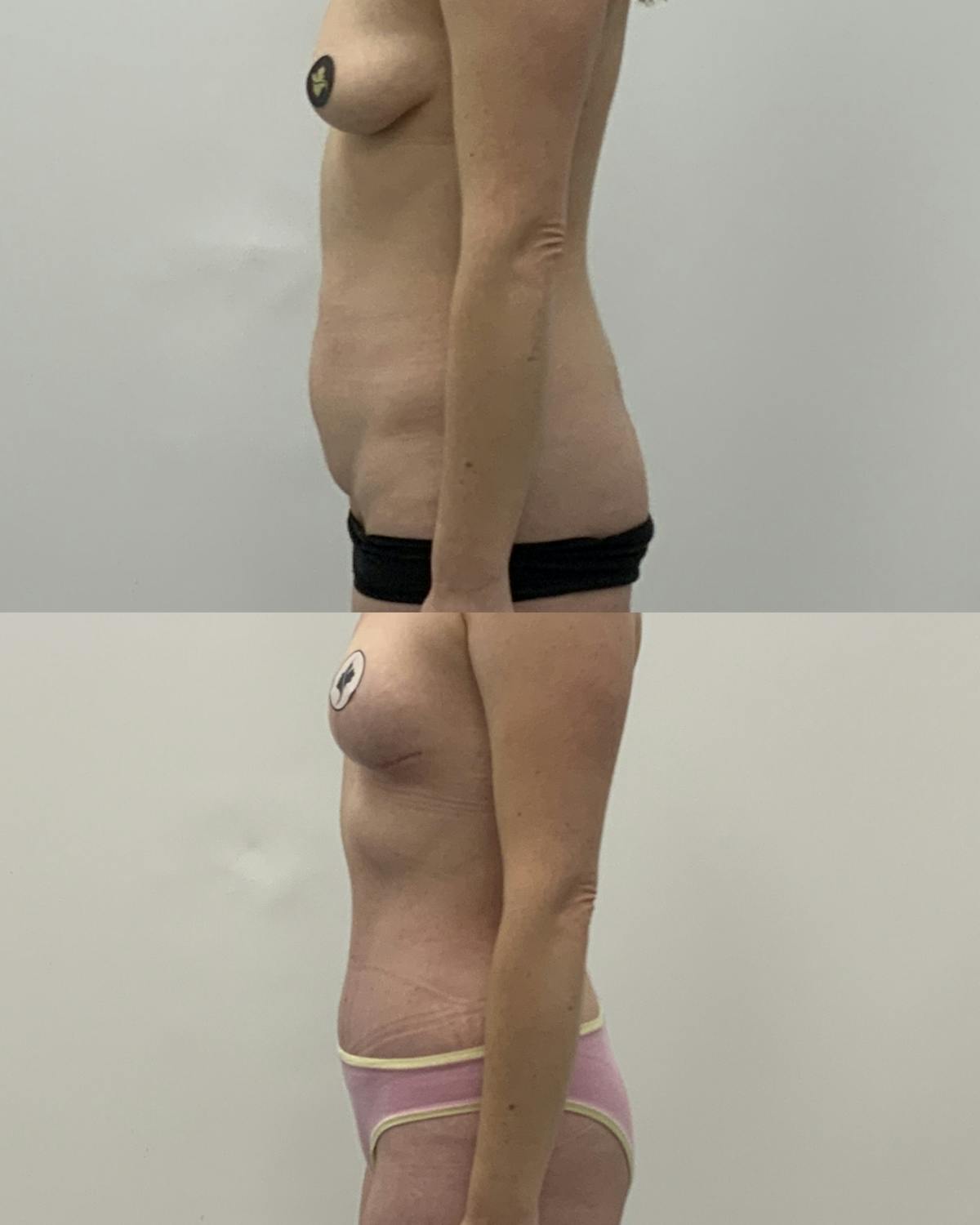Tummy Tuck Before & After Gallery - Patient 243321 - Image 3