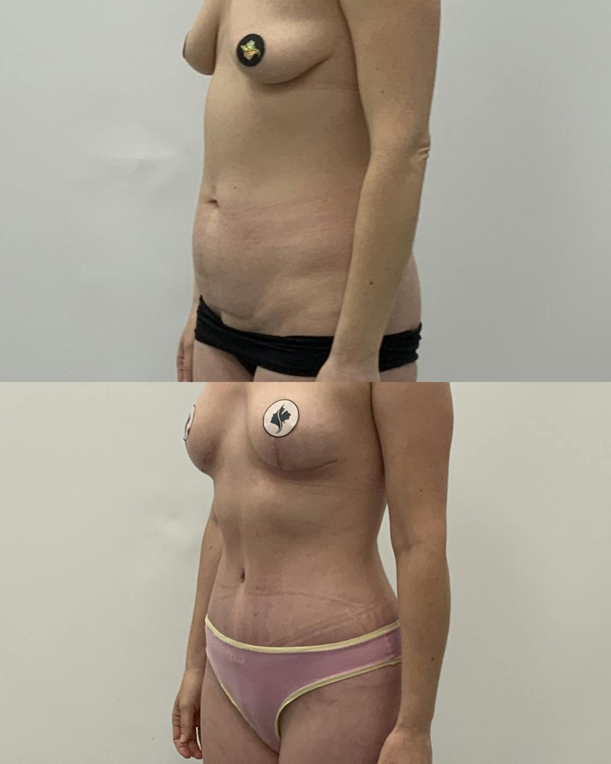 Tummy Tuck Before & After Gallery - Patient 243321 - Image 2