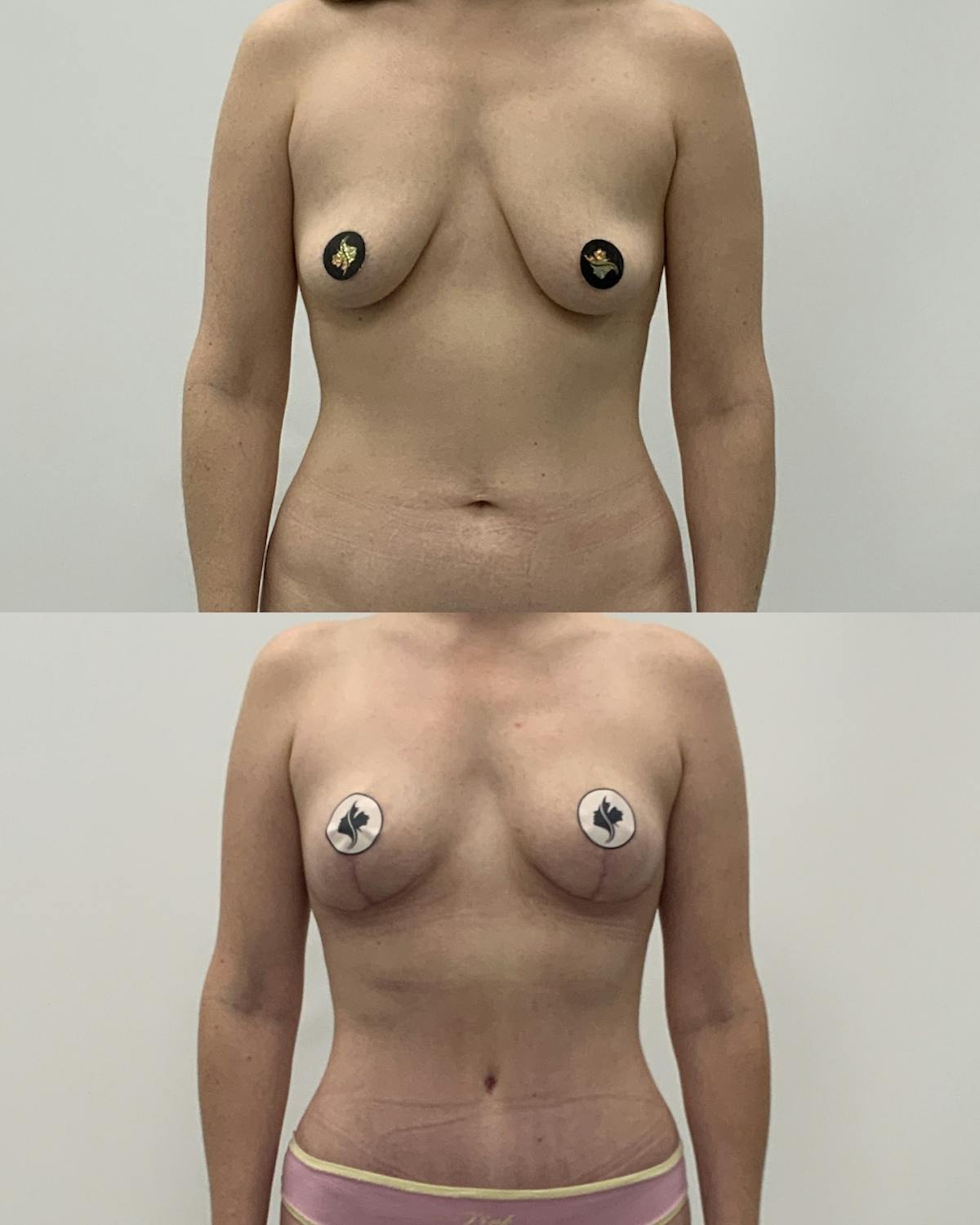 Breast Asymmetry Correction Before & After Gallery - Patient 314579 - Image 1