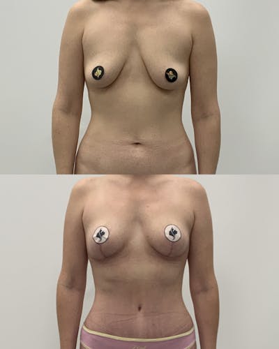 Breast Lift Before & After Gallery - Patient 166485 - Image 1