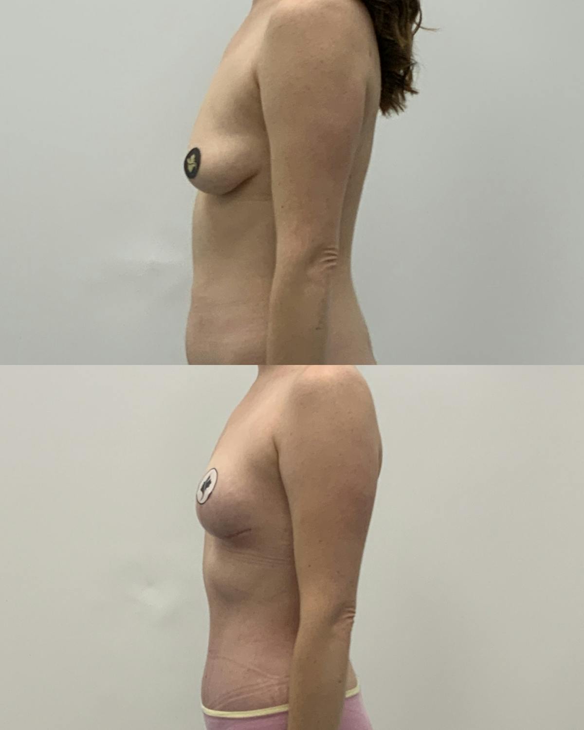 Breast Asymmetry Correction Before & After Gallery - Patient 314579 - Image 3