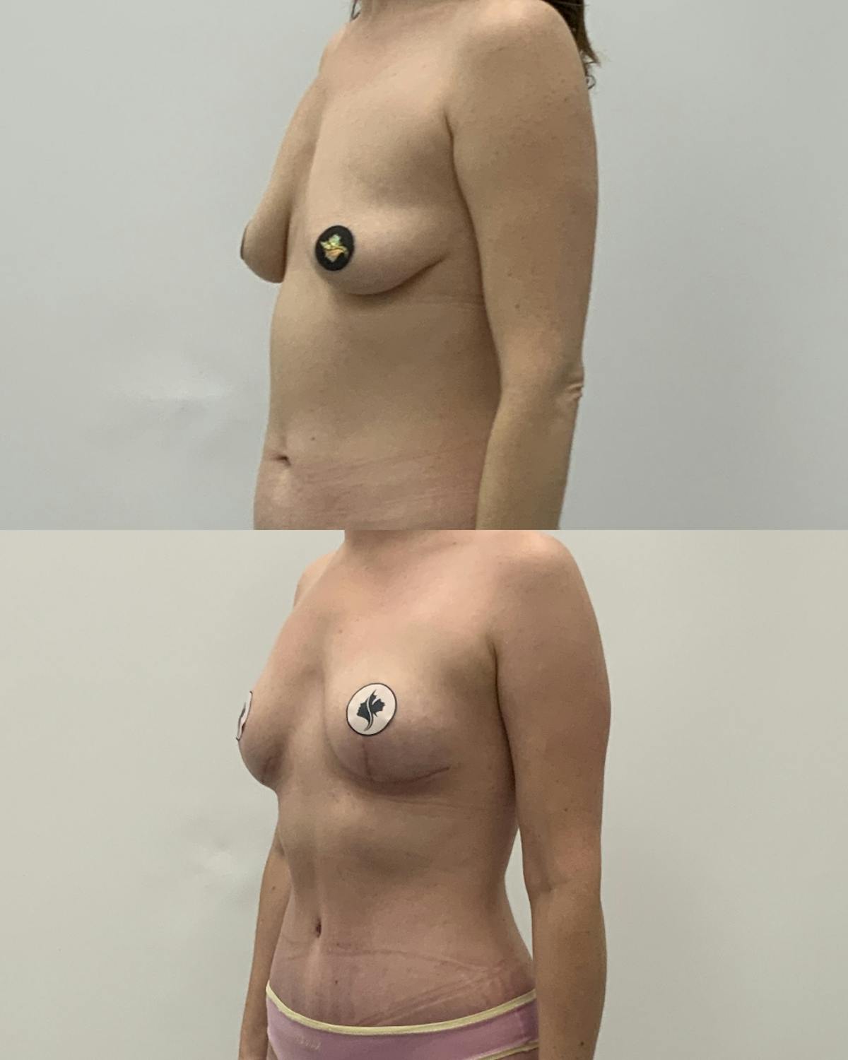 Breast Asymmetry Correction Before & After Gallery - Patient 314579 - Image 2