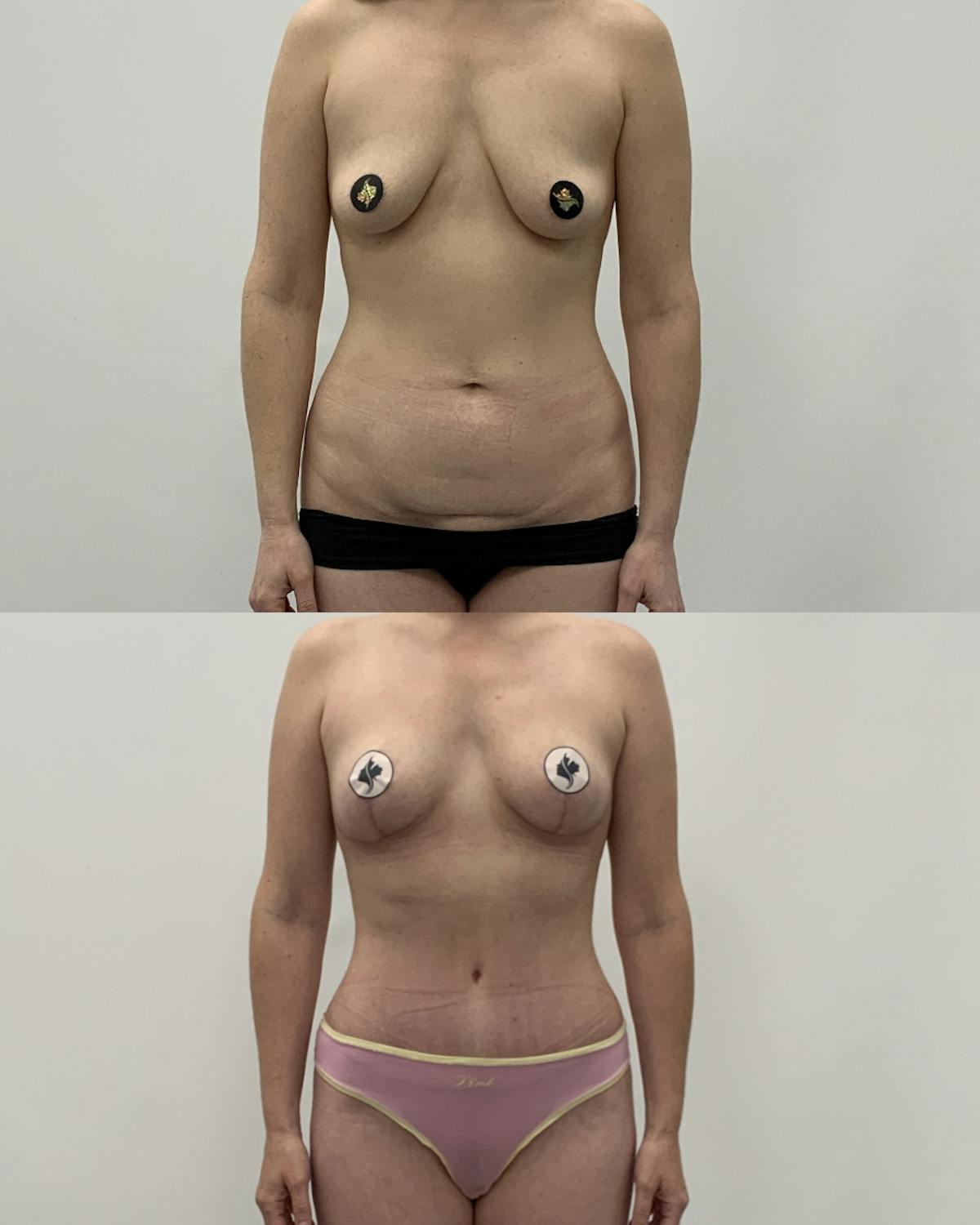 Mommy Makeover Before & After Gallery - Patient 320626 - Image 1