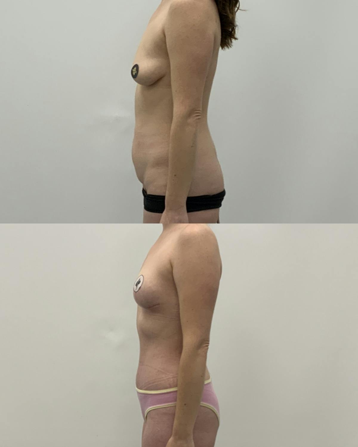 Mommy Makeover Before & After Gallery - Patient 320626 - Image 3