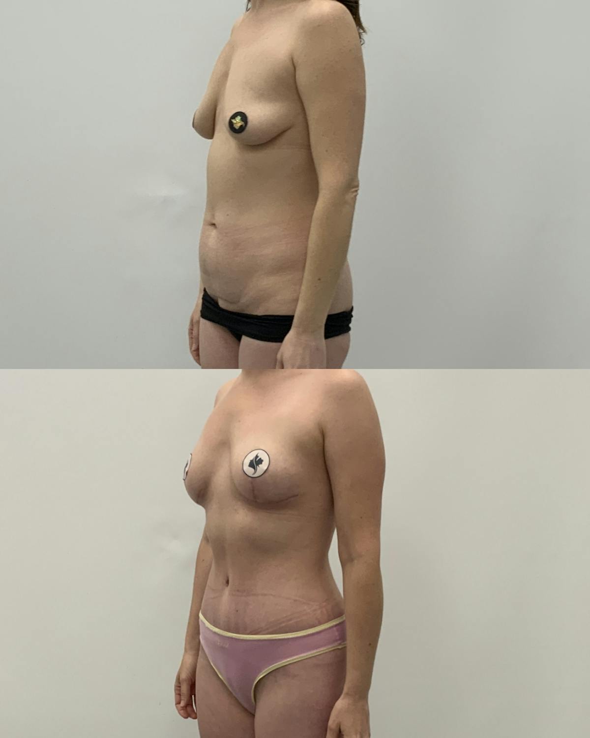 Mommy Makeover Before & After Gallery - Patient 320626 - Image 2
