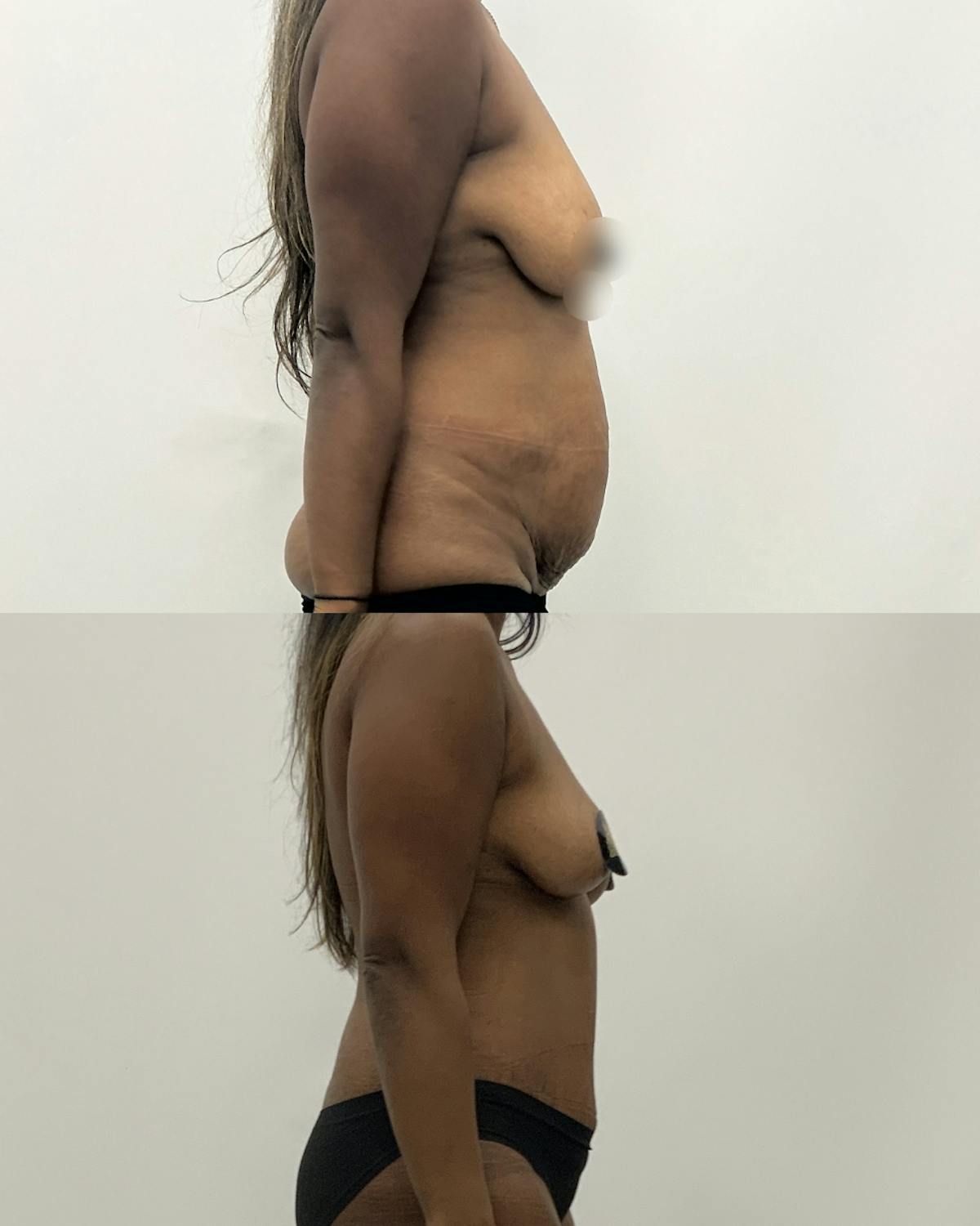 Mommy Makeover Before & After Gallery - Patient 883575 - Image 3