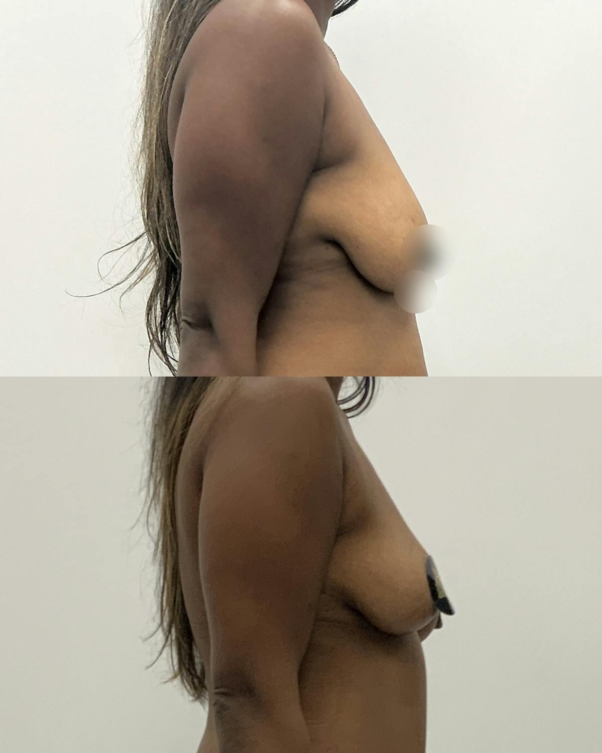 Breast Asymmetry Correction Before & After Gallery - Patient 220153 - Image 3
