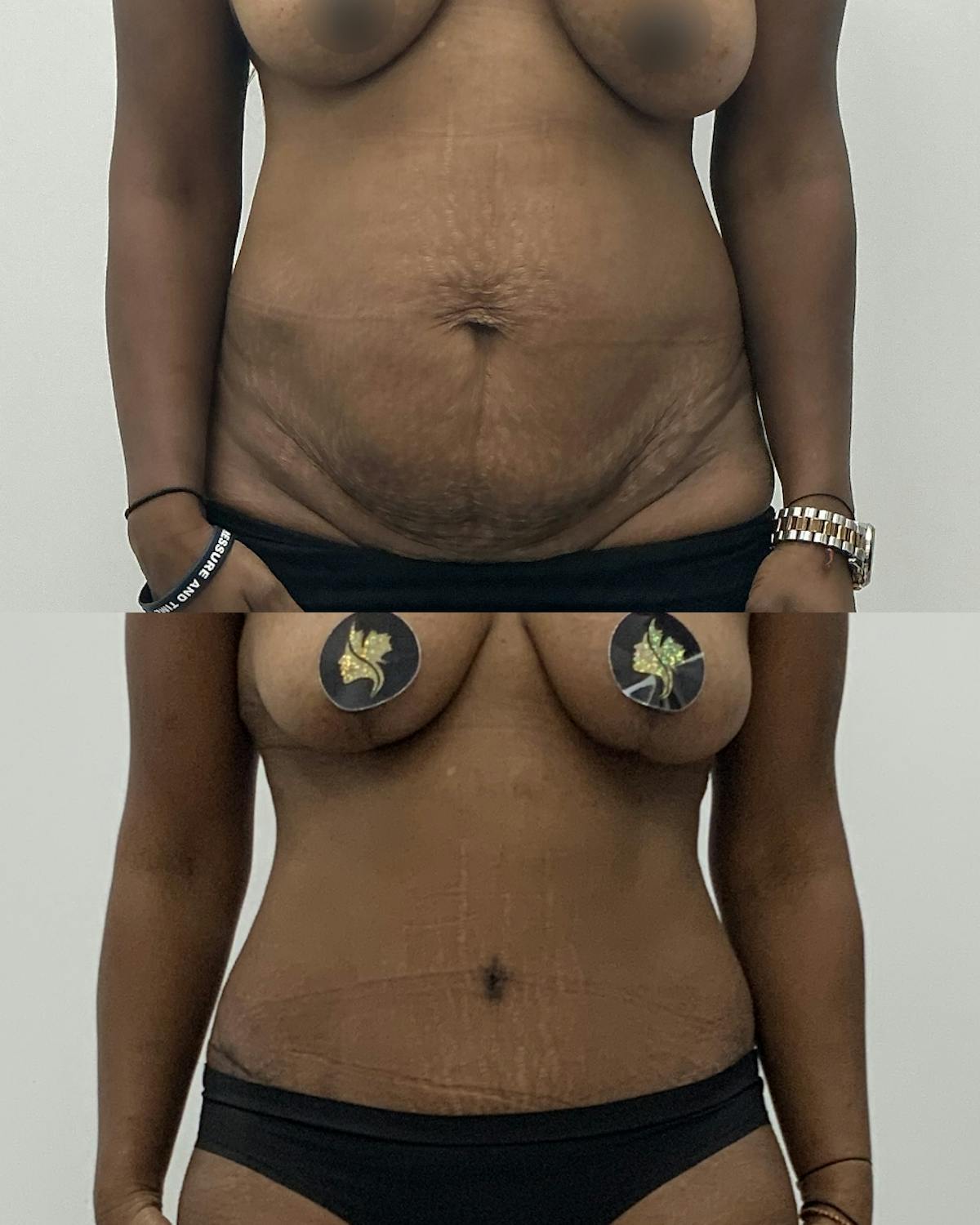 Tummy Tuck Before & After Gallery - Patient 148098 - Image 1
