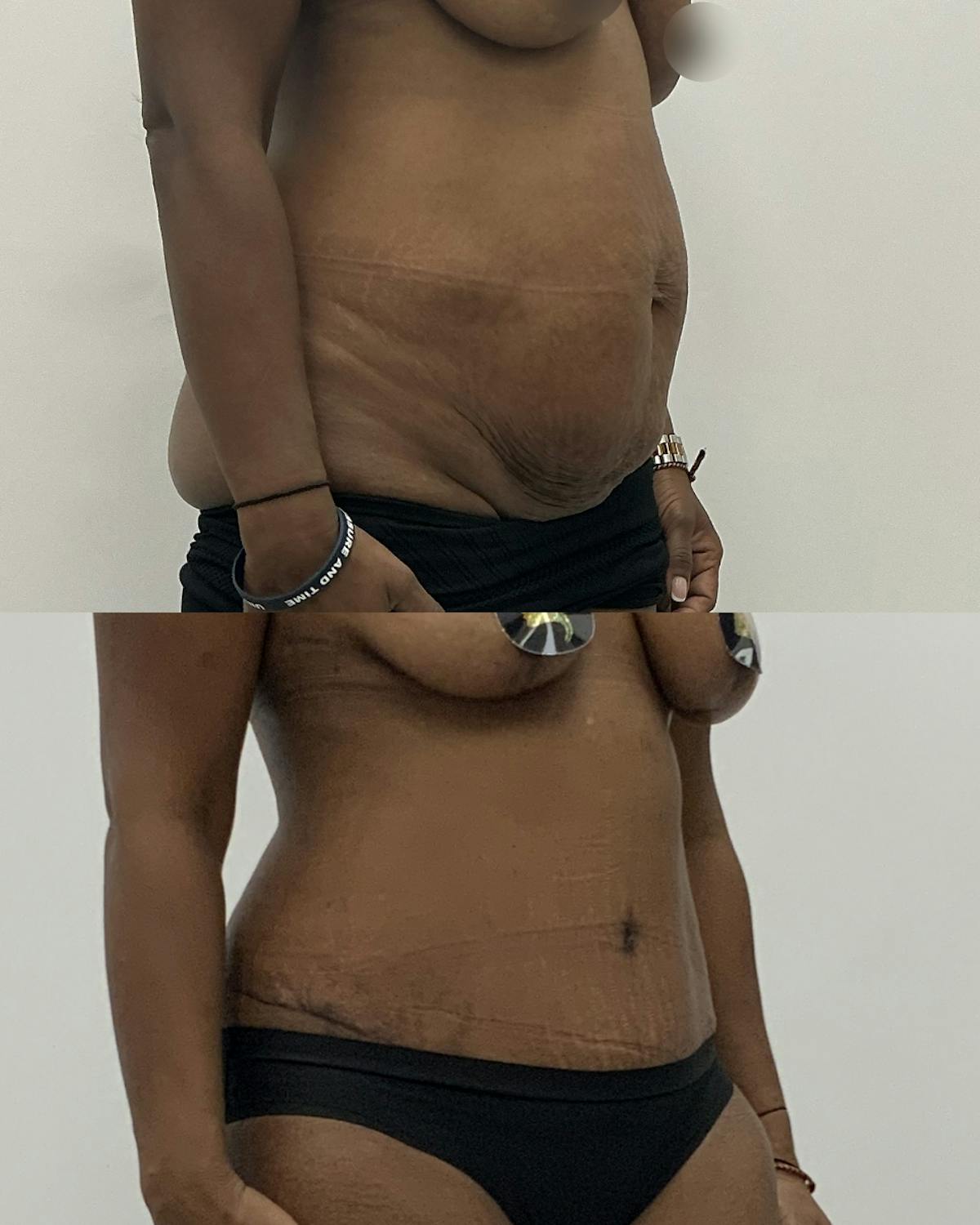 Tummy Tuck Before & After Gallery - Patient 148098 - Image 2