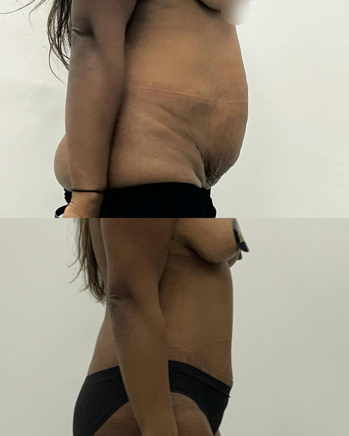 Tummy Tuck Before & After Gallery - Patient 148098 - Image 3