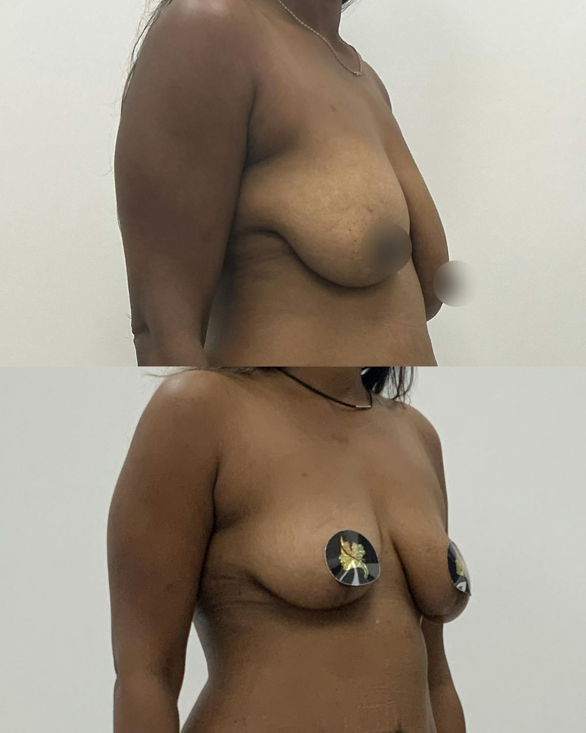 Breast Asymmetry Correction Before & After Gallery - Patient 220153 - Image 2