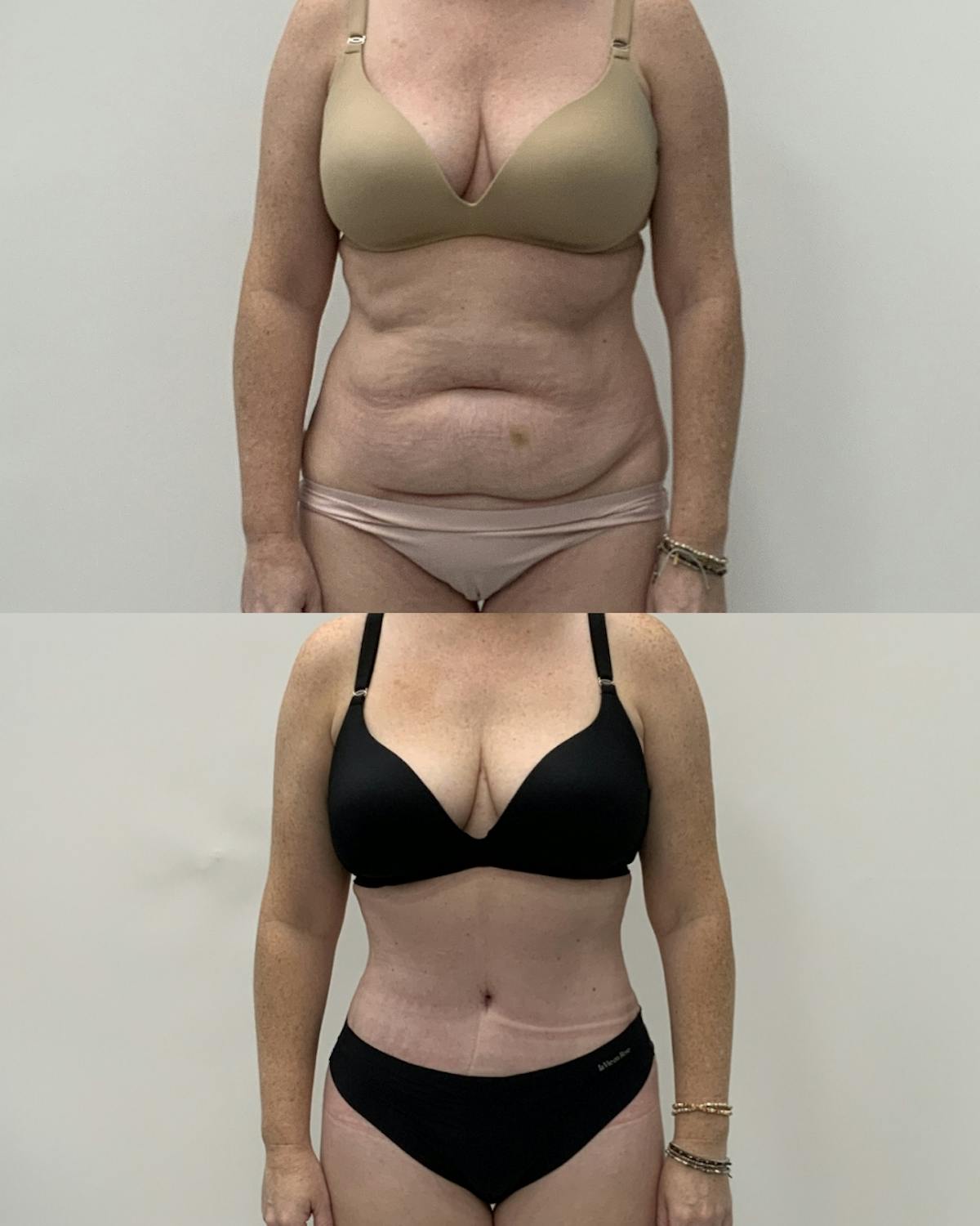 Tummy Tuck Before & After Gallery - Patient 758213 - Image 1