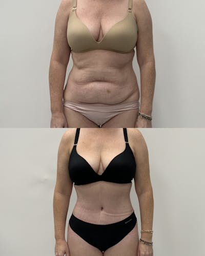 Tummy Tuck Before & After Gallery - Patient 758213 - Image 1