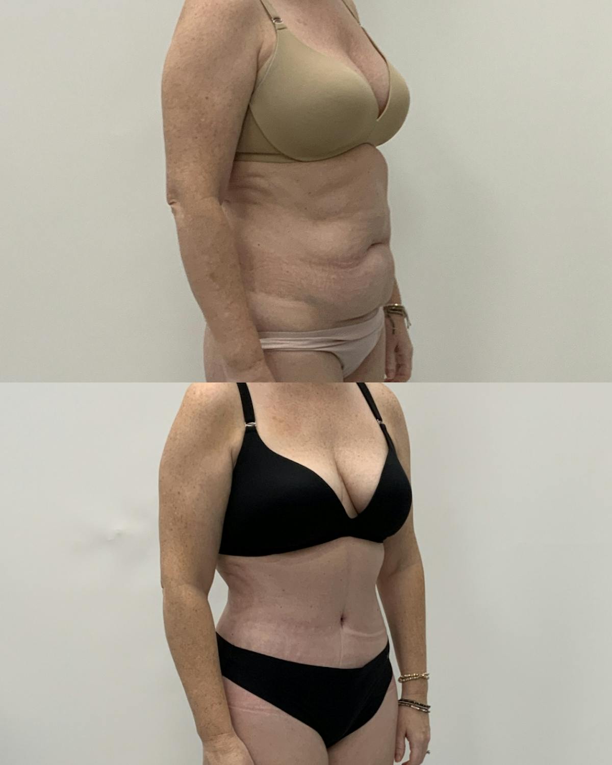 Tummy Tuck Before & After Gallery - Patient 758213 - Image 2