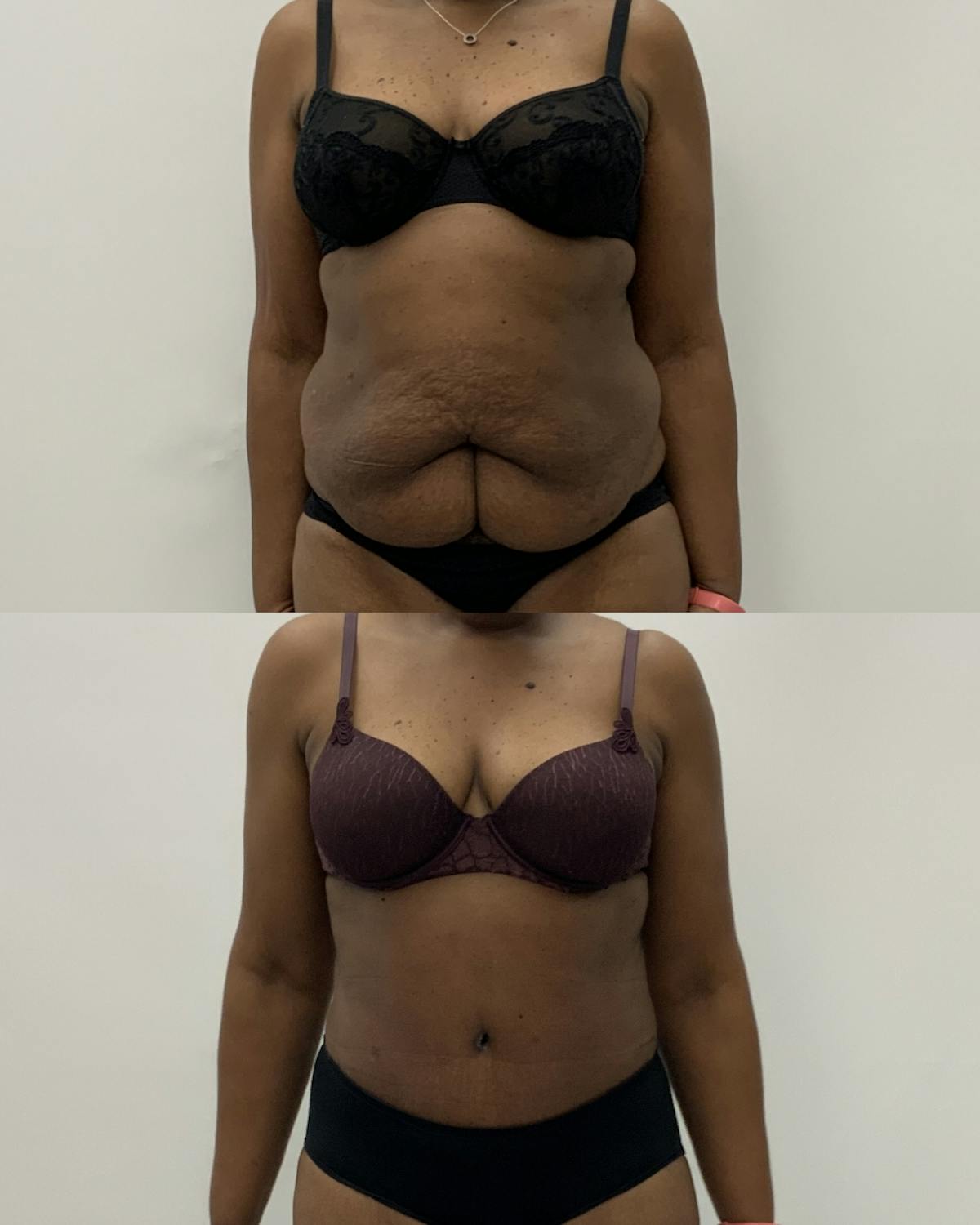 Tummy Tuck Before & After Gallery - Patient 360544 - Image 1