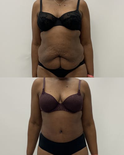 Tummy Tuck Before & After Gallery - Patient 360544 - Image 1