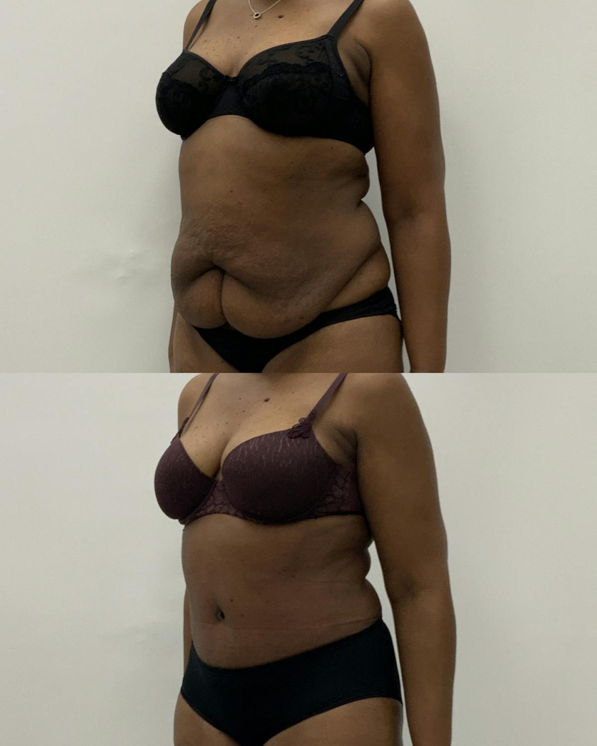 Tummy Tuck Before & After Gallery - Patient 360544 - Image 2