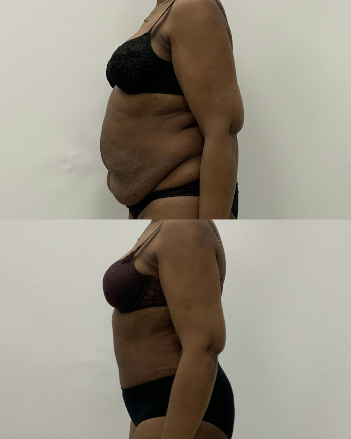 Tummy Tuck Before & After Gallery - Patient 360544 - Image 3