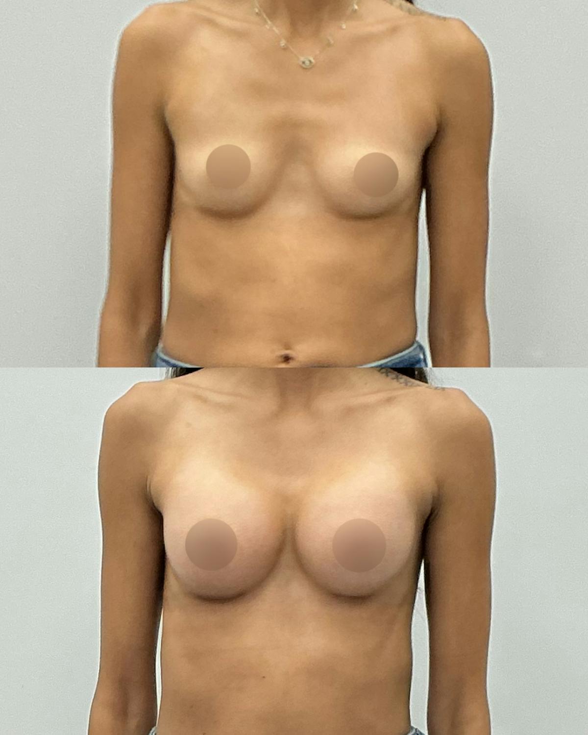 Breast Augmentation Before & After Gallery - Patient 602416 - Image 1