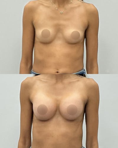 Breast Augmentation Before & After Gallery - Patient 602416 - Image 1