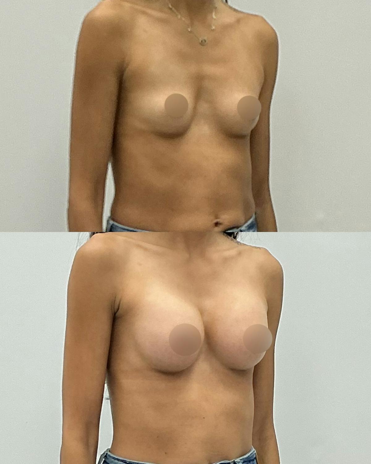 Breast Augmentation Before & After Gallery - Patient 602416 - Image 2