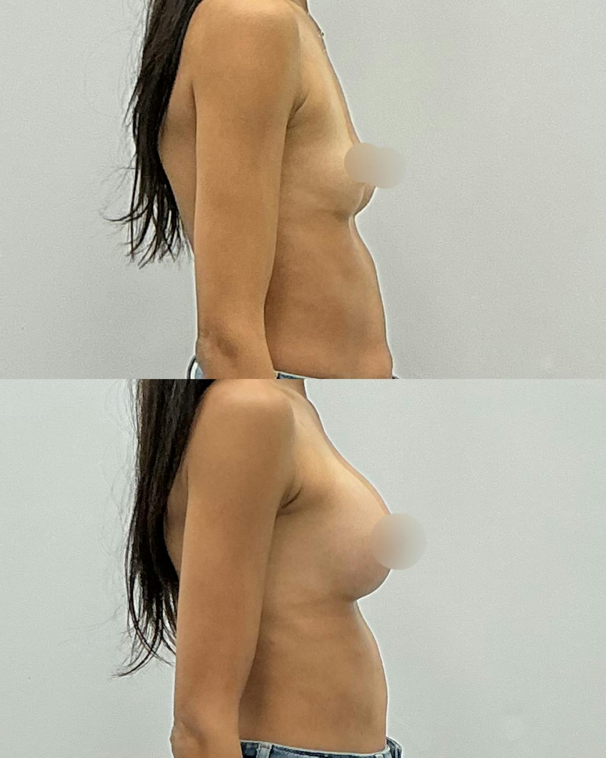 Breast Augmentation Before & After Gallery - Patient 602416 - Image 3